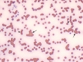 Immune-mediated hemolytic anemia (IMHA)