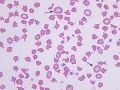 Poikilocytosis