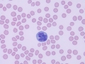 Reactive lymphocyte