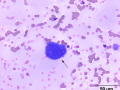 Cryoglobulin & platelet clump