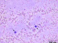 Cryoglobulin