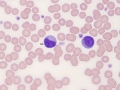 Reactive & granular lymphocyte