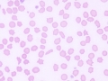 Poikilocytosis