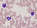Neutrophil & lymphocyte