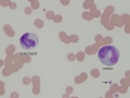 Toxic band & monocyte