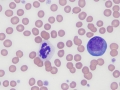 Reactive lymphocyte