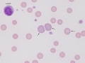 Regenerative anemia