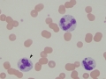 Toxic neutrophils