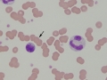 Granular lymphocyte & toxic neutrophil