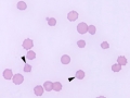 Oxidant-induced hemolytic anemia