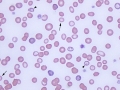 Hypochromasia