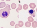 Dysplastic nRBC