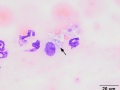 Histiocyte (cytophagic)