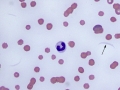 Pancytopenia & toxic band
