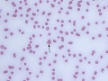 Pancytopenia & agglutination