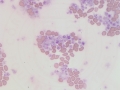 Platelet clump