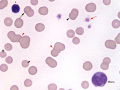 Mycoplasma, Heinz bodies & WBC