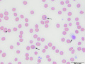 Siderocytes & Heinz bodies