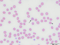 Siderocytes & Heinz bodies