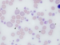 Thrombocytosis