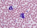 Toxic neutrophil & monocyte