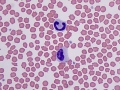 Toxic band neutrophils