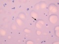 Feline infectious peritonitis