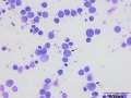 Lymphoma of granular lymphocytes