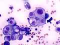 Carcinoma