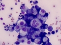 Suspect carcinoma