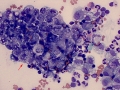 Carcinoma
