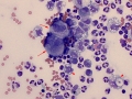 Carcinoma