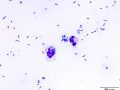Septic peritonitis