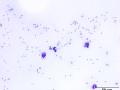 Septic peritonitis