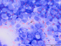 Vaginal urothelial carcinoma