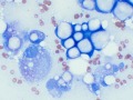 Mammary lipid-rich carcinoma (dog)