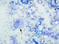 Mammary lipid-rich carcinoma (dog)