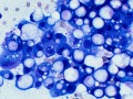 Lipid-rich mammary carcinoma (dog, DQ)