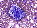 Ovarian tumor
