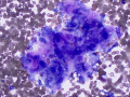 Ovarian tumor