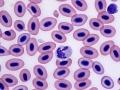 Toxic neutrophil