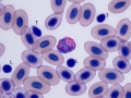Eosinophil & lymphocyte