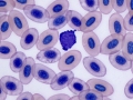 Reactive lymphocyte