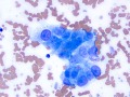 Hemangiosarcoma