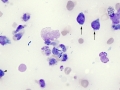 Lymphoma & GI bugs (intestine)