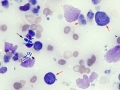 Lymphoma & GI bugs (intestine)