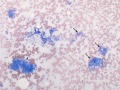 GIST or leiomyosarcoma