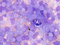 Lymphoma of granular lymphocytes
