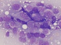 Lymphoma of granular lymphocytes