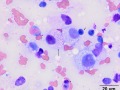 Mast cell tumor (Wright